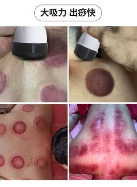 电热吸痧按摩仪全身肩颈拔罐刮痧罐负压温灸疏通经络器家用走罐仪