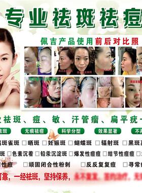 专业祛斑祛痘广告点痣海报宣传画祛疤中药图片效果对比图海报画专