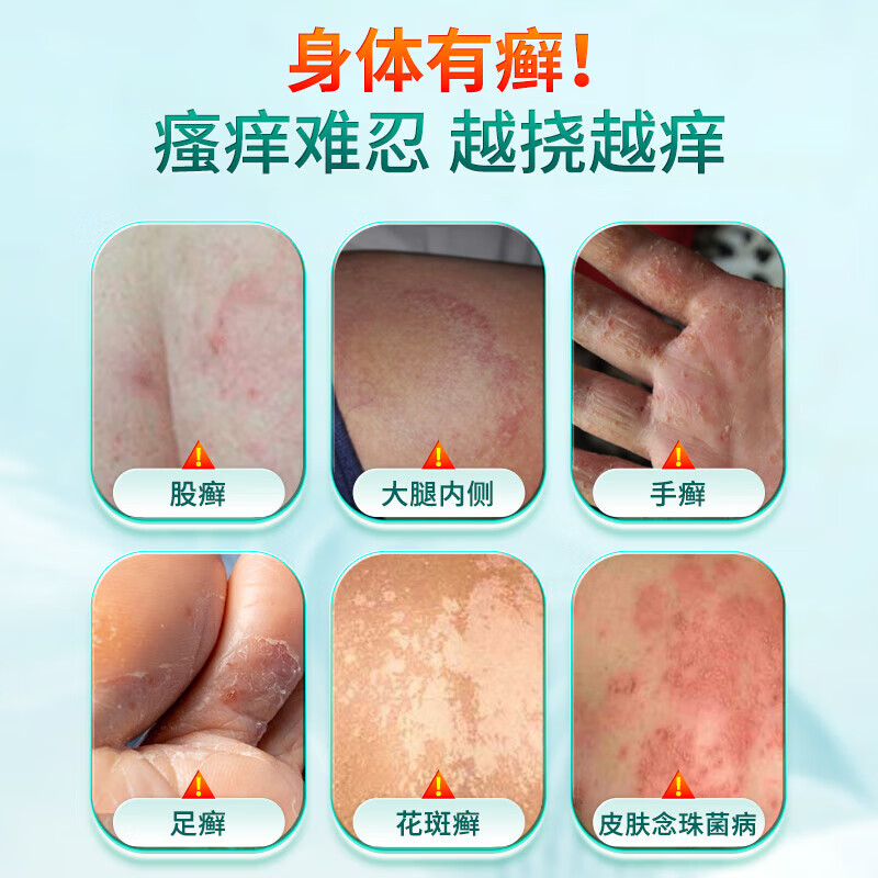 股藓大腿内侧真菌感染皮肤皮炎湿疹阴囊潮湿瘙痒杀菌止痒药膏