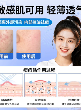 Auslka全面全脸痘痘贴去豆豆粉刺