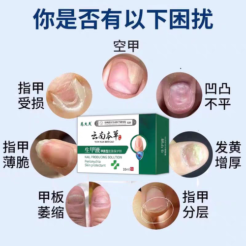 手指甲游离线生长液儿童空甲养甲肉分离修复液萎缩受损再生增长TT - 图0