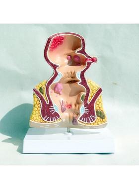 直肠内痔疮病变模型痔FCT疮门外解剖肛肛肠科大肠直肠病理模型