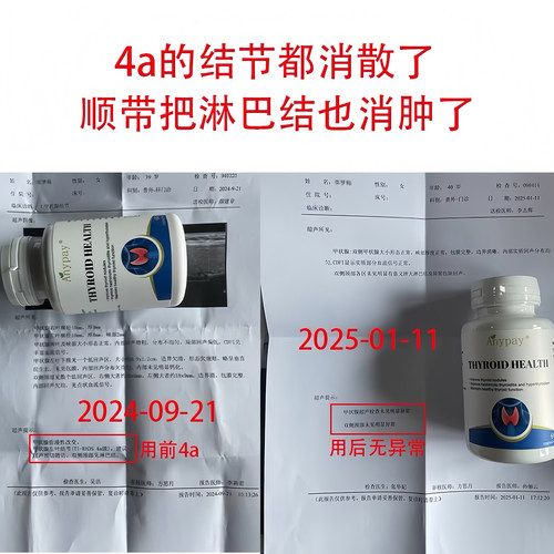 猫爪草胶囊散结节消除甲减甲状腺结节功能减退甲亢突眼特效中成药 - 图0