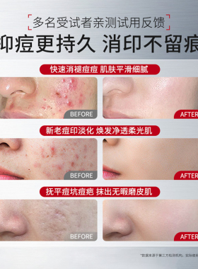 碧诺斯祛痘净肤凝胶水杨酸草本净痘舒缓泛红预防反复长痘