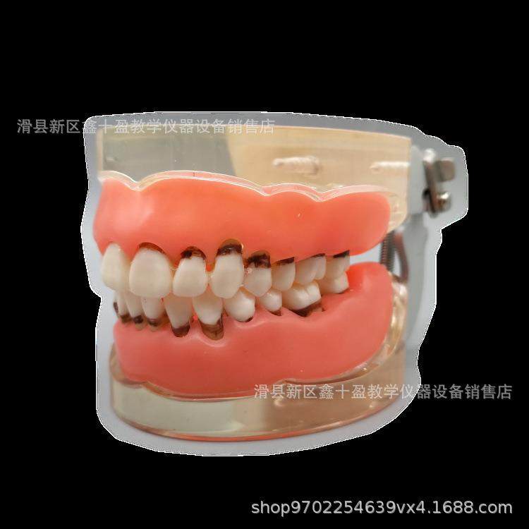 牙科病牙理模型结牙石萎缩55870牙龈缺失牙牙周洁治术练周习软牙,淘宝优惠券,粉丝福利购,淘宝优惠卷