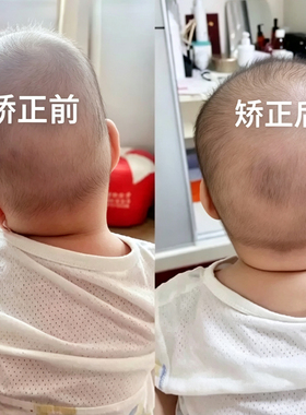 定制款医院同款儿童斜颈矫正器