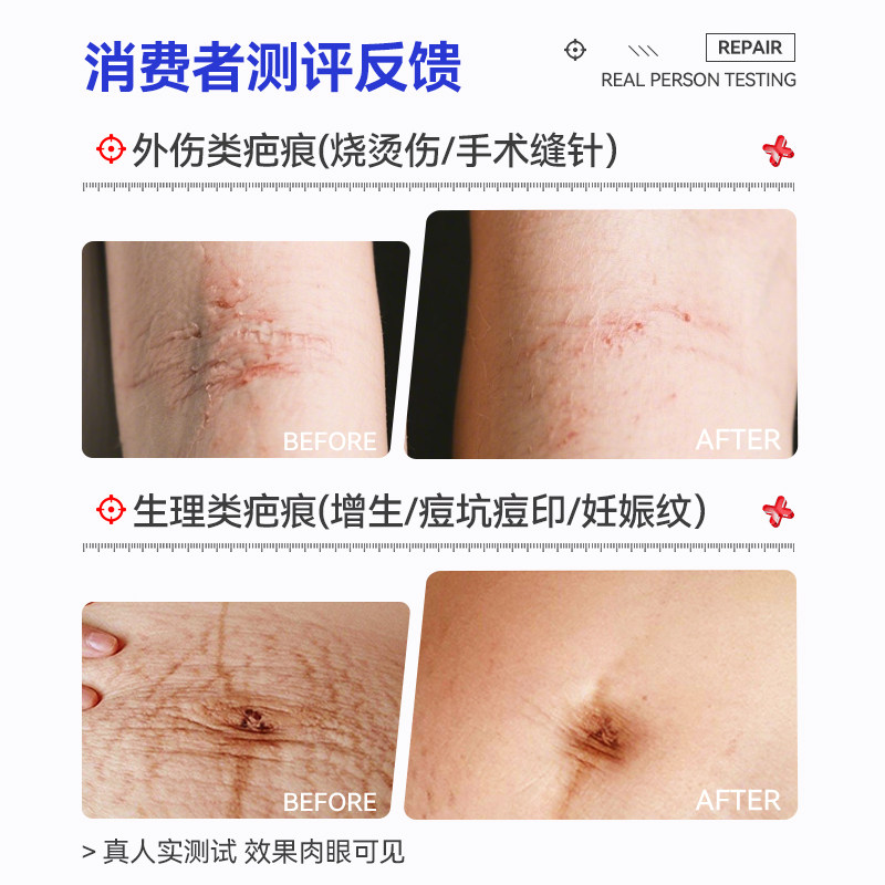 LAPOR医用疤痕凝胶祛疤膏去疤淡印疤痕修复官方正品30g/支A
