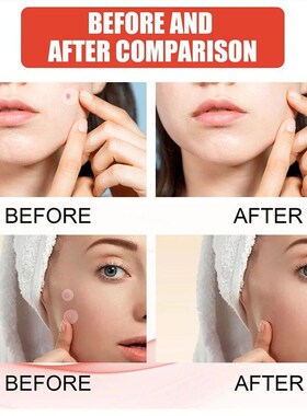 240Pcs New High-end Pimple Patch Acne Patches Heart/Star