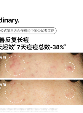 2%水杨酸精华收缩毛孔淡化痘印