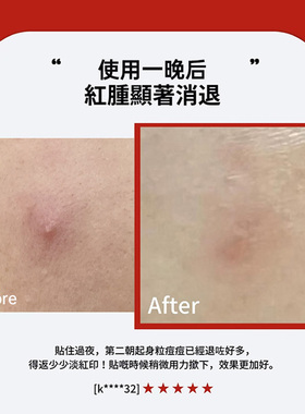 curesys痘痘贴微针修复暗疮贴