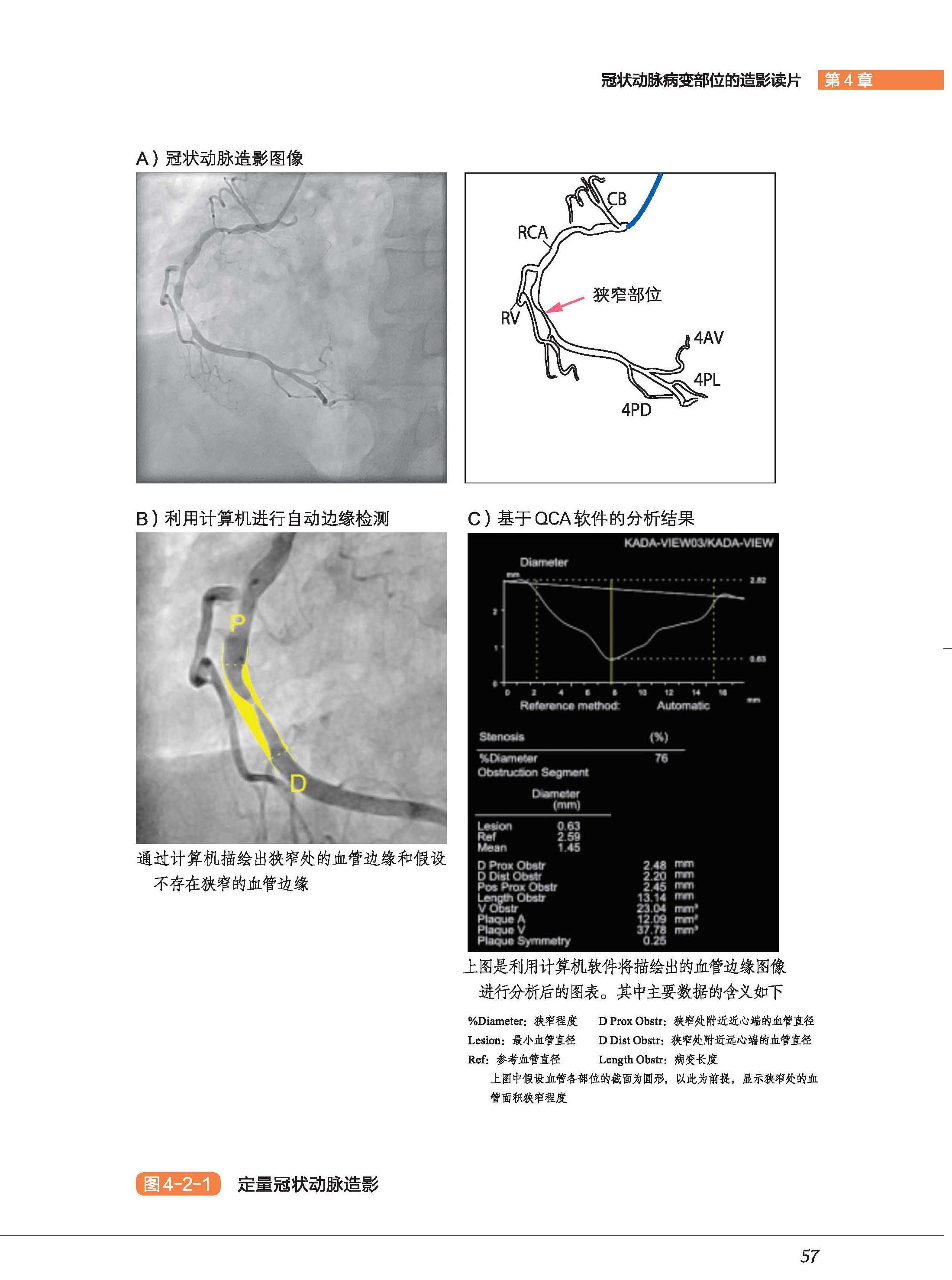 正版包邮 冠状动脉造影读片技巧图解 正常及异常造影 教你从冠脉造影小白 快速进阶PCI达人中川义久林秀隆 北京科学技术出版 - 图2
