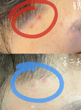 oliveyoung隐形痘痘贴