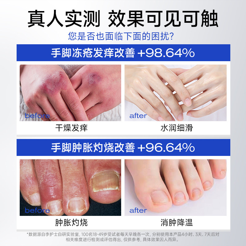 医用冻疮膏止痒冻伤膏耳朵消肿儿童防冻防裂正品特效修复护手足霜,淘宝优惠券,粉丝福利购,淘宝优惠卷