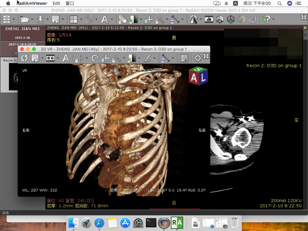 RadiAnt DICOM Viewer医学影像浏览查看三维重建MRP软件苹果macOS - 图0