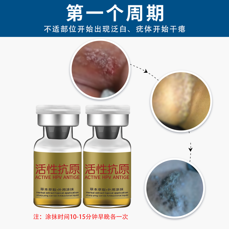 尖锐湿疣宫颈炎hpv感染扁平疣凝胶 元荣私处护理（器械）