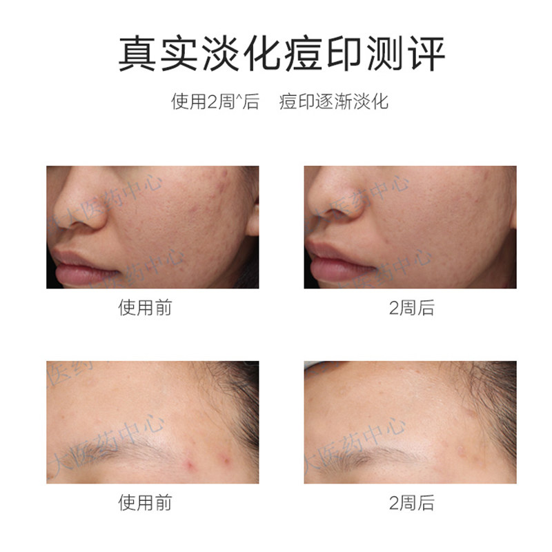 韩后烟酰胺寡肽冻干粉祛痘印精华液 韩后贝臣液态精华