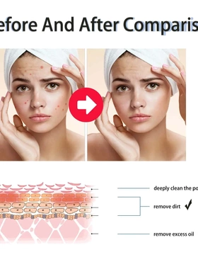 Salicylic Acid Acne SerumFade Acne MarksRepair Acne SkinGent