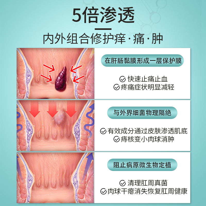 【自营】痔疮有消肉球痔根断正品男康卡波姆速达医用痔疮冷敷凝胶 - 图1