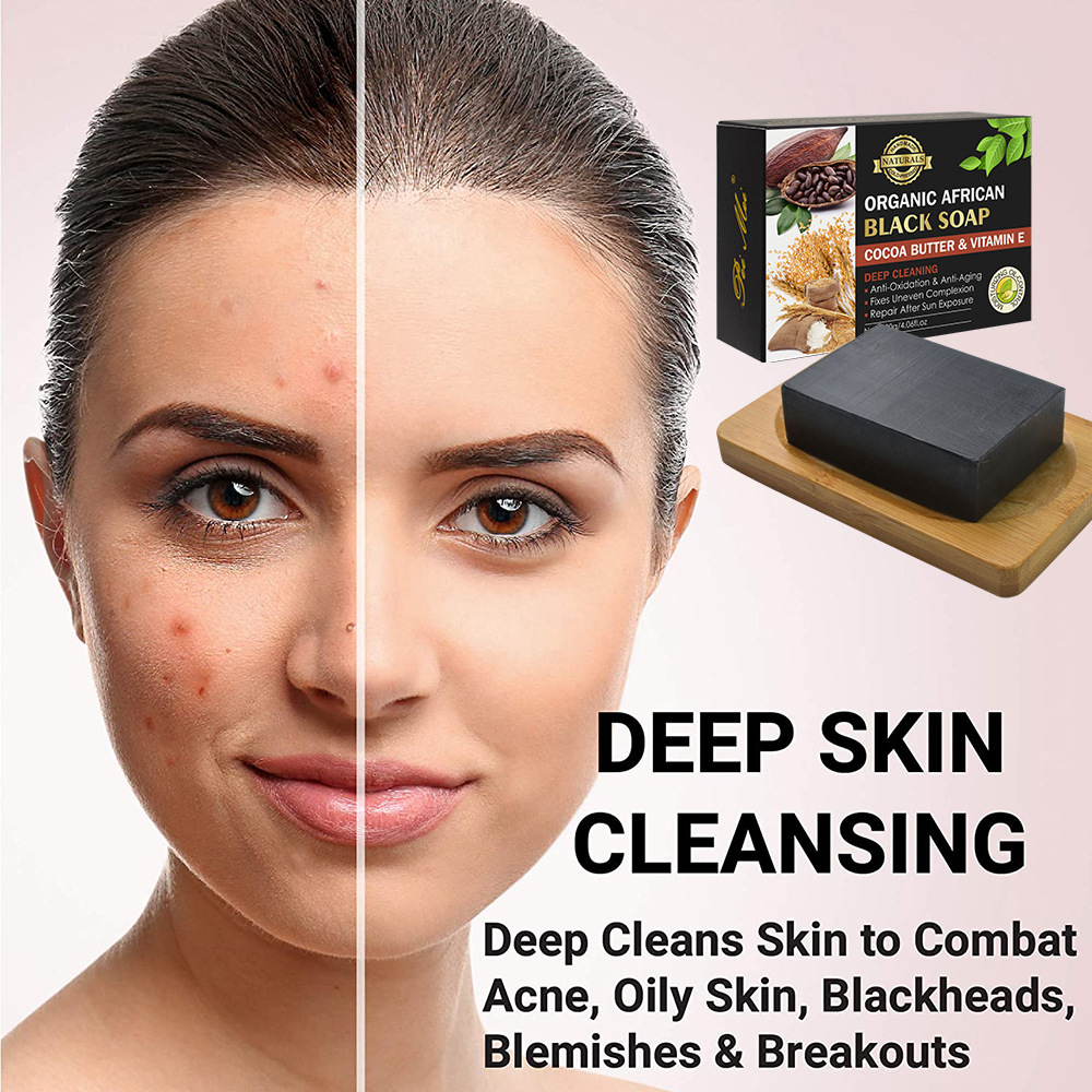 organic african black soap oil acne skin blackhead blemishes - 图1