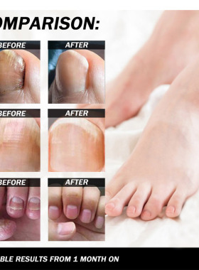 eelhoe nail repair fungal oil Treatment foot bright nail car