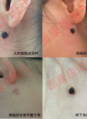 面康痣斑王去除痣疣不忌口不忌水