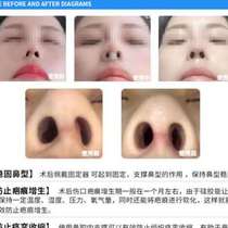 Integrated Longnose Post Nostril Nostril Support Prevents Nasal Hyperplasia Nasal Septum Trilogy Crooked Nose Small Column Straightener