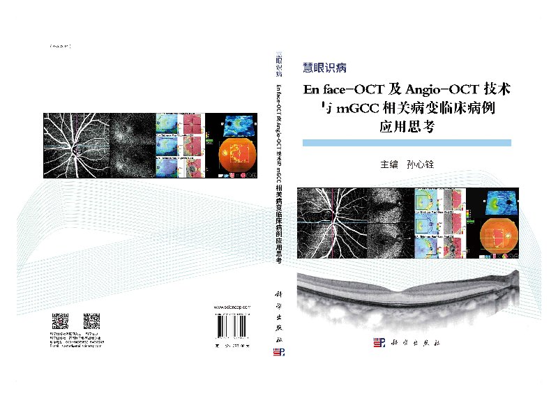 En face-OCT及Angio-OCT技术与mGCC相关病变临床病变应用思考-图2