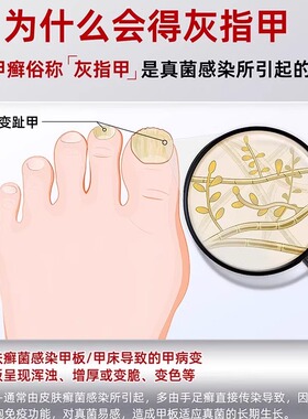2026新款灰指甲光疗机医用级灰趾真菌灯紫外线抑灭菌仪家用智能