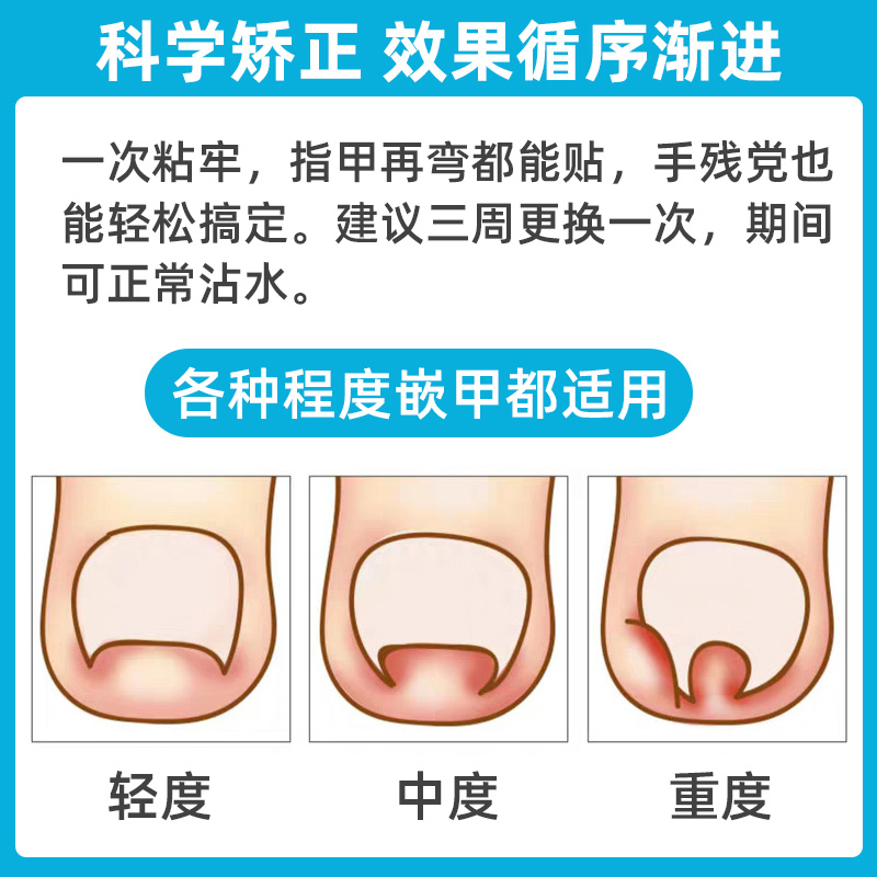 可孚嵌甲矫正器甲沟贴脚炎正甲贴片拉拉修脚专用刀剪指甲纠正神器 - 图3