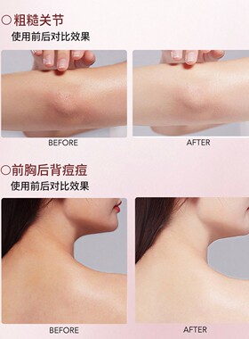 次抛棉片｜SD淳存2%复合乳酸净背美肤棉片水杨酸牛奶刷酸背痘消