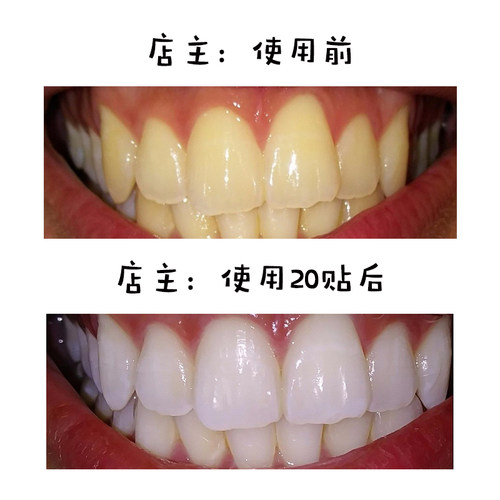 佳洁士牙贴美国版crest 3d white加强版炫白牙齿亮白去黄祛渍20对 - 图3