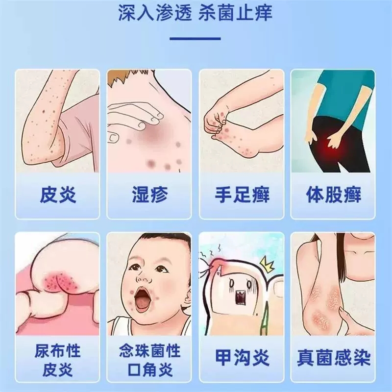 仁和曲安奈德益康唑乳膏益康挫脚气药膏真菌感染去癣专用湿疹膏yy - 图0