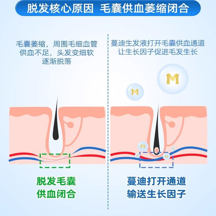 蔓迪米诺地尔酊5%正品男用生发水曼迪米诺地尔酊官方旗舰店洗发水