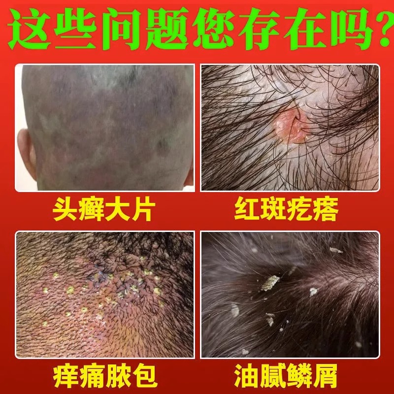 头皮屑毛囊炎专用洗发水上海磺硫洗头膏仁和头癣头屑严重去屑止痒-图1