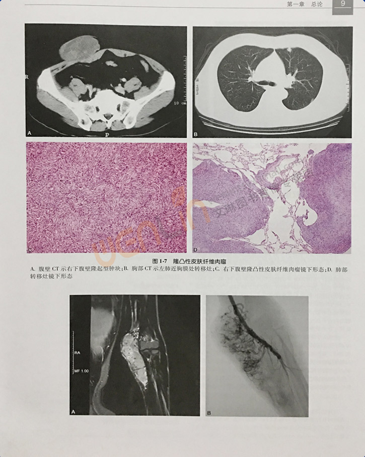 正版软组织肿瘤病理学第2版第二版王坚朱雄增肿瘤医学临床案例教程图谱大内科学参考工具书籍人民卫生出版社9787117247849-图3