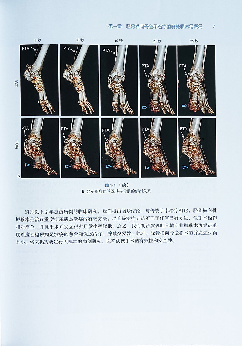 胫骨横向骨搬移治疗重度糖尿病足 花奇凯 治疗重度糖尿病足的新方法 手术技巧 相关注意事项 北京大学医学出版社9787565927102