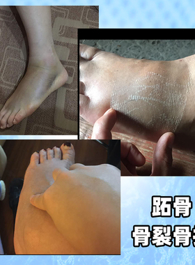 踝关节胫腓骨固定支具脚踝脚腕