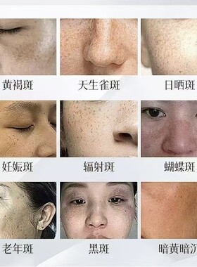 无尴尬期免提取祛斑液排色液代谢液分解色素适用各类斑点和肤质