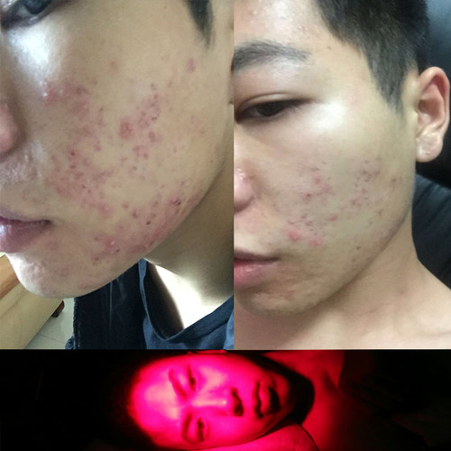 IPL红蓝光美容仪脸部嫩肤电子光子嫩肤仪痤疮N4800红光生发器 - 图2