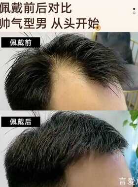 额M型补发全真精致发际线贴全真人发假发发际线贴家用收纳
