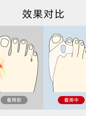 外翻矫正器成人外翻矫正器脚趾