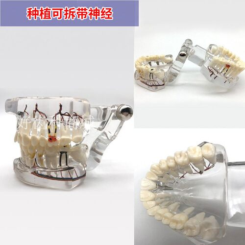 牙科教学模型口腔全口牙齿病理修复体牙模型标准种植模具医患沟通 - 图0