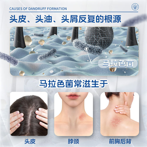 999二硫化硒洗剂医用去屑头屑旭发止痒脂溢头皮屑洗发水洗头水 - 图1