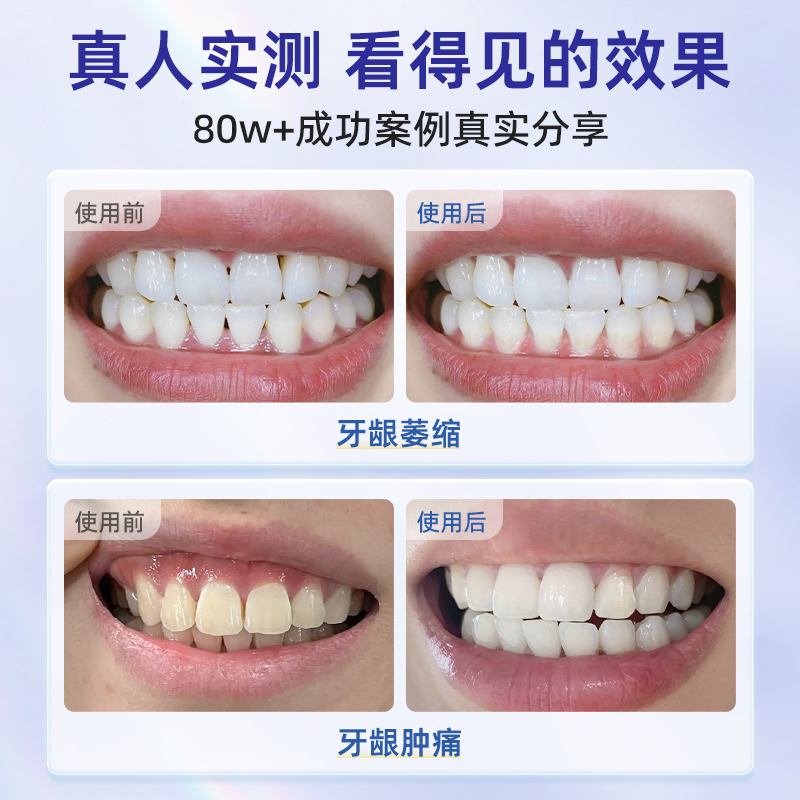 牙龈萎缩修复再生专用牙膏治牙周炎口腔护理牙龈出血肿痛医用脱敏-图1