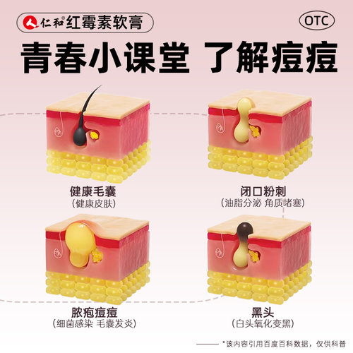 仁和红霉素软膏外用官方旗舰店正品消炎消炎药痤疮私处药膏医用 - 图2