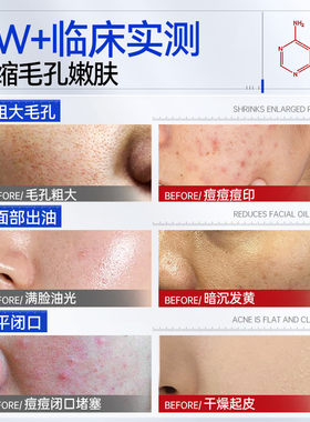 【胖東莱爆款】全新升级水杨酸
