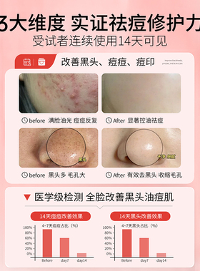 15%壬二酸凝胶乳膏祛痘膏淡化痘印去黑头粉刺水杨酸闭口收毛孔