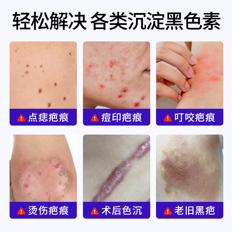 德国去除痘印黑印去疤印脸部淡化沉着修复皮肤祛疤痕膏三型人源化