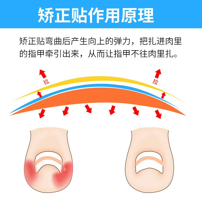 正甲贴甲沟嵌甲矫正器脚趾甲贴片拉拉专用指甲刀钳趾甲修脚套装炎 - 图2