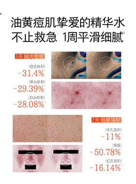 hfp莓酶溜溜水控油舒缓保湿